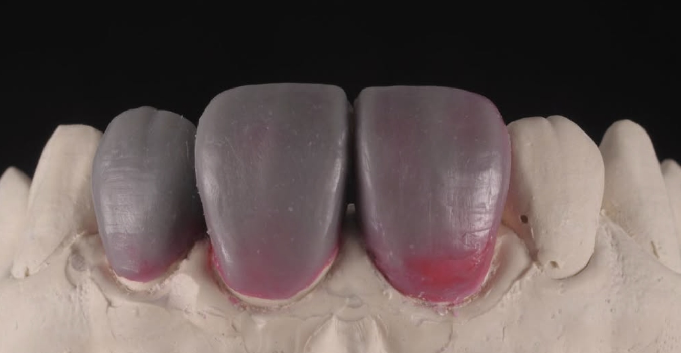 Shade Matching Case 04